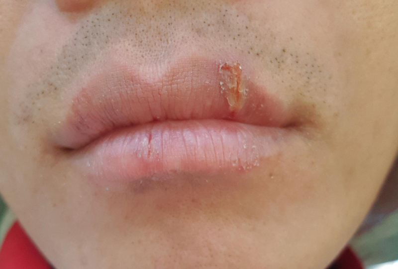 Can I take valtrex for cold sores? RemoteDerm