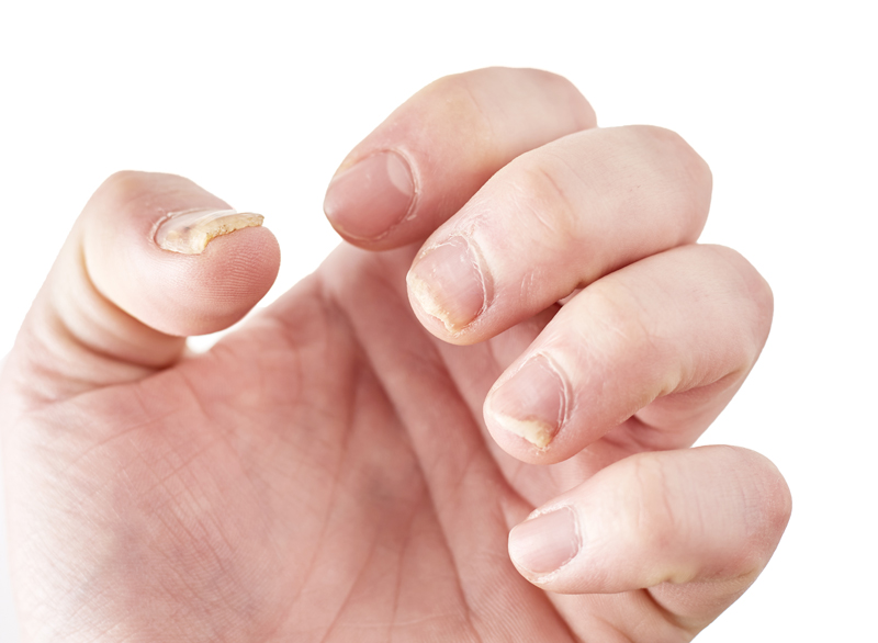 What Causes Brittle Nails? RemoteDerm