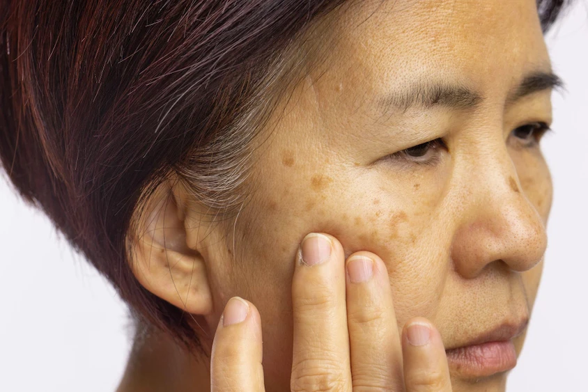 Image showing Melasma skin condition